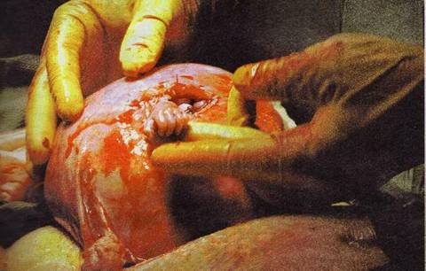 Unborn Baby Grabs Surgeon